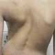 scoliosis_square